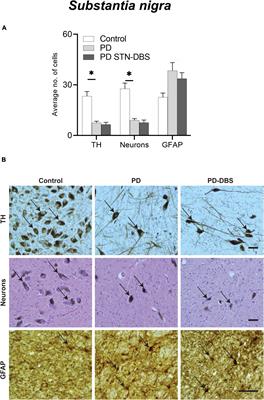 Post-mortem brain histological examination in the substantia nigra and subthalamic nucleus in Parkinson’s disease following deep brain stimulation